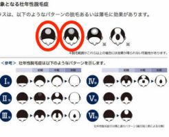 発毛剤リアップの発毛効果