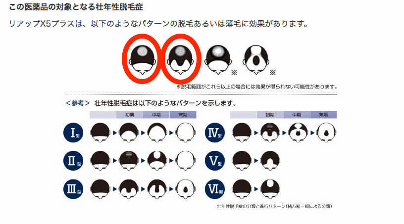 発毛剤リアップの発毛効果